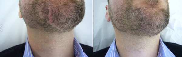 Dermopigmentation alopécie barbe