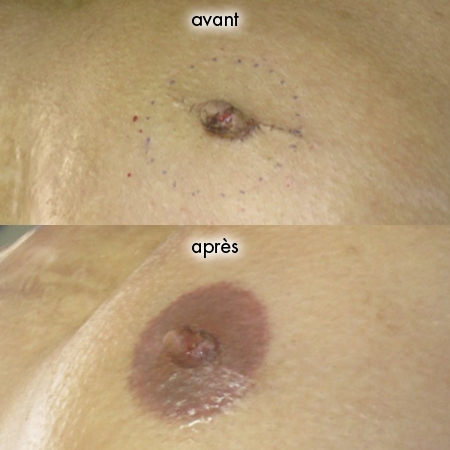 Dermopigmentation des aréoles des seins