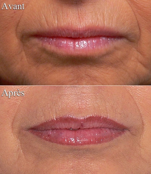 Dermopigmentation des lèvres