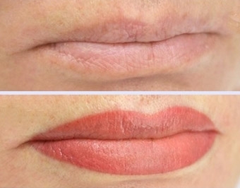Dermopigmentation des lèvres